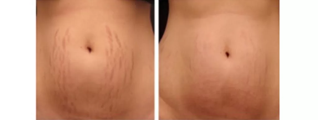 cosmetic acupuncture treatment before and after photo