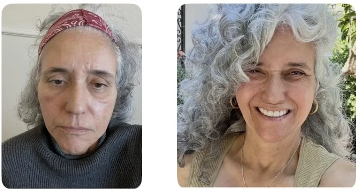 before and after microneedling photo